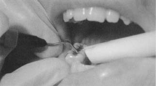 A dentist removes decay from a tooth.