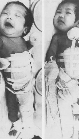 Month-old Siamese twin boys recuperate after being surgically separated in Taipei, Japan. The twins had been joined at the chest.