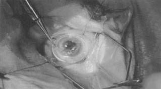 A corneal transplant.